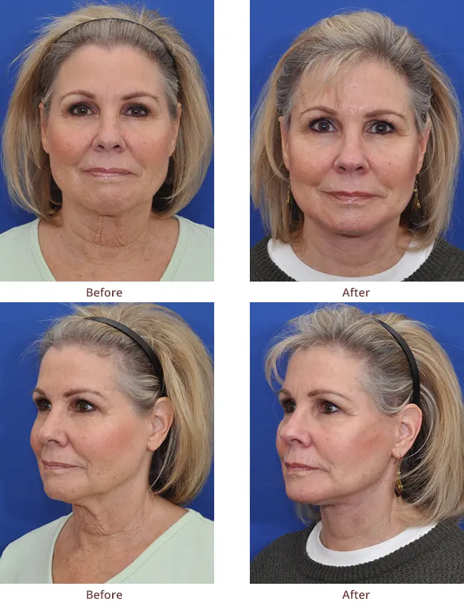 Bellingham Neck Lift Before And After Photos